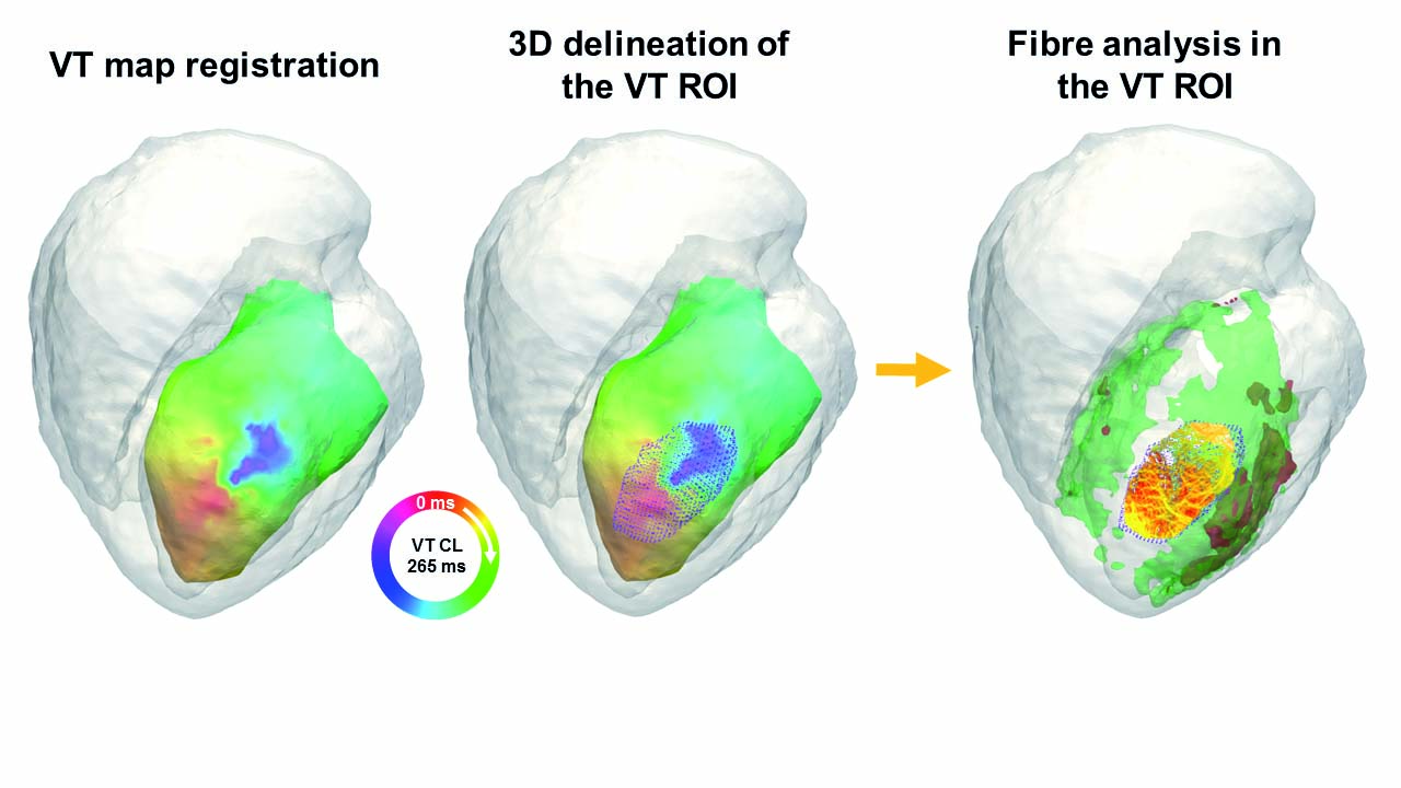 Figure 2c tractography vt map analysis