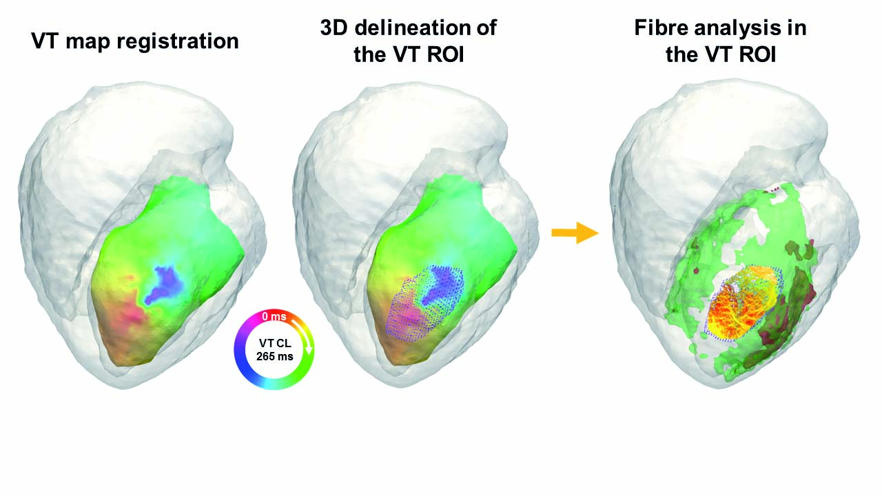 figure-2c-tractography-vt-map-analysis-copia Figure 2c tractography vt map analysis