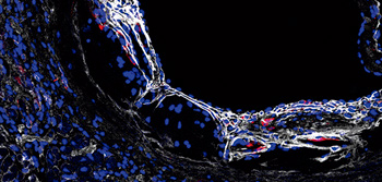 Collagen deposition in an atherosclerotic plaque in the aortic root of a progeroid Apoe-/- LmnaG609G/G609G mouse fed a high-fat diet for 8 weeks, starting at 8 weeks of age. Red, alpha smooth muscle actin; white, collagen III; blue, Hoechst 33342. (Vicente Andrés)