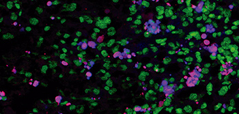 Liver-infiltrating neutrophils stained with anti-Mrp14 (blue) and anti-NE (red); nuclei are stained with with Sytox Green. (Magdalena Leiva, Guadalupe Sabio).
                                                