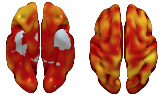 Scientists uncover early links between cardiovascular risk and brain metabolism