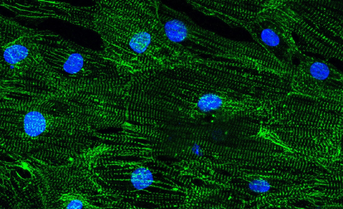 Study reveals how Duchenne muscular dystrophy causes heart rhythm problems