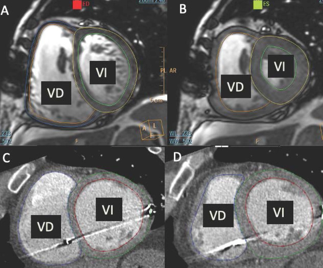 A promising drug treatment for patients with pulmonary hypertension associated with heart disease