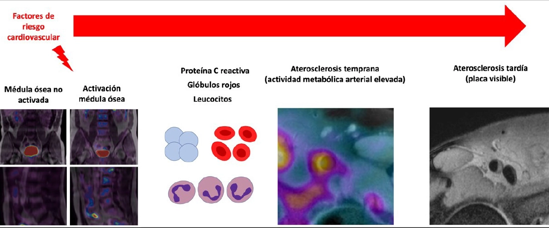 Bone marrow contributes to the development of atherosclerosis