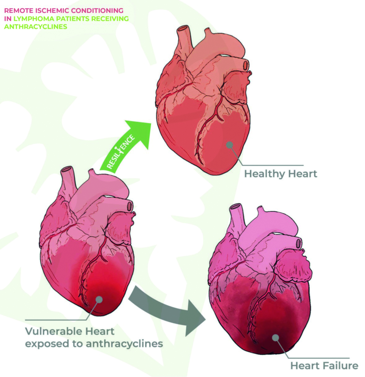 European Journal Heart Failure The RESILIENCE trial preventing heart injury caused by anticancer drugs