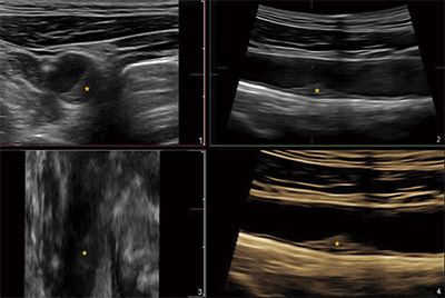 JACC. Atherosclerosis progresses rapidly in healthy people
from the age of 40