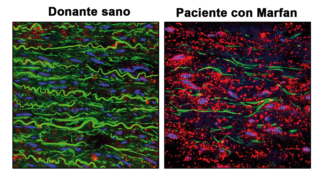 Donante sano y paciente con Marfan