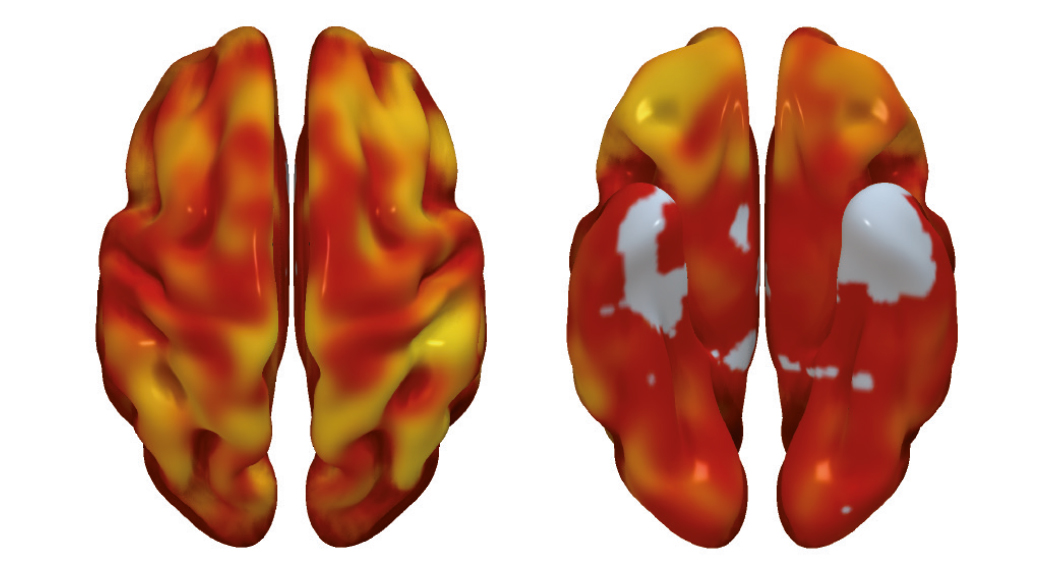 Desvelan la precoz asociación entre el riesgo cardiovascular y el metabolismo cerebral