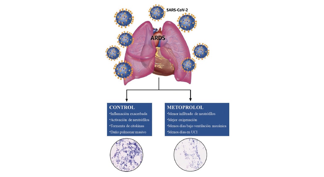 A drug costing less than €2 a day helps in the treatment of severely ill COVID-19 patients