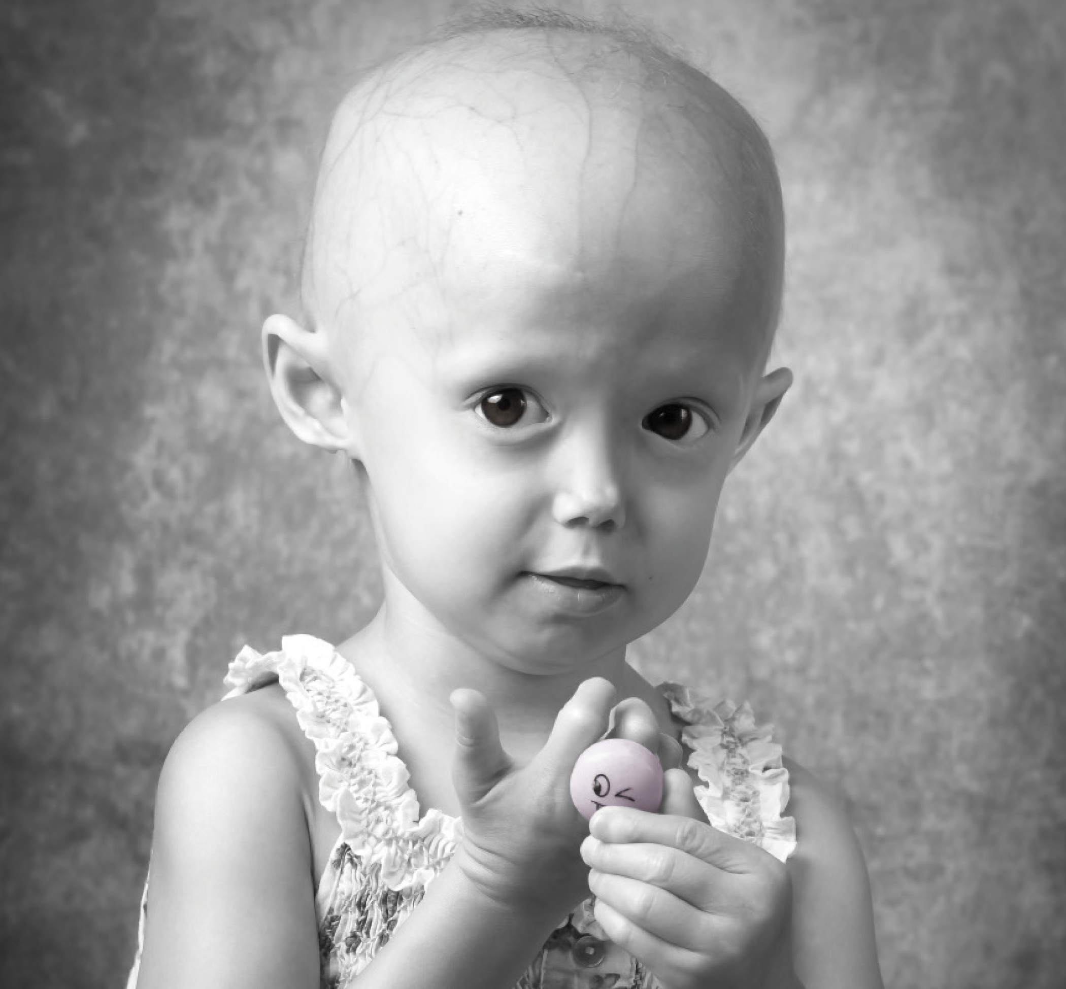 Progeria Alexandra Peraut Association