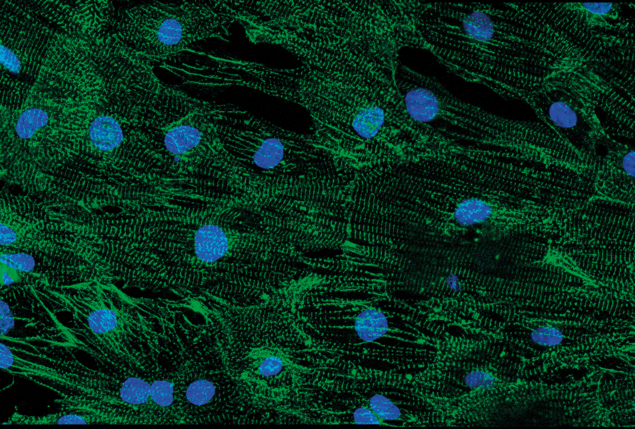 Study reveals how Duchenne muscular dystrophy causes heart rhythm problems