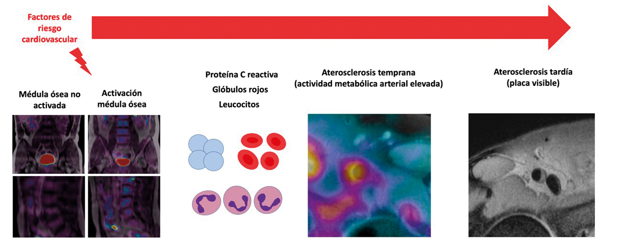 Bone marrow contributes to the development of atherosclerosis