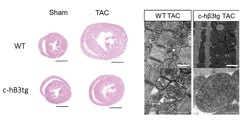 A new therapeutic target for the prevention of heart failure due to aortic stenosis