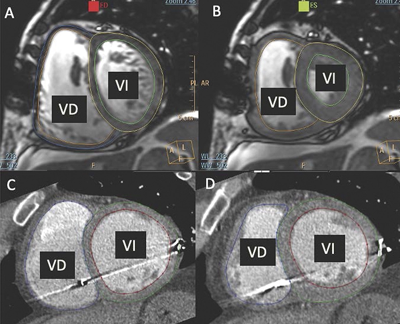 A promising drug treatment for patients with pulmonary hypertension associated with heart disease