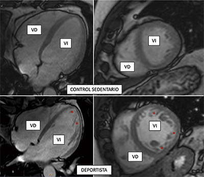 JACC. Ejercicio vigoroso, corazón esponjoso
