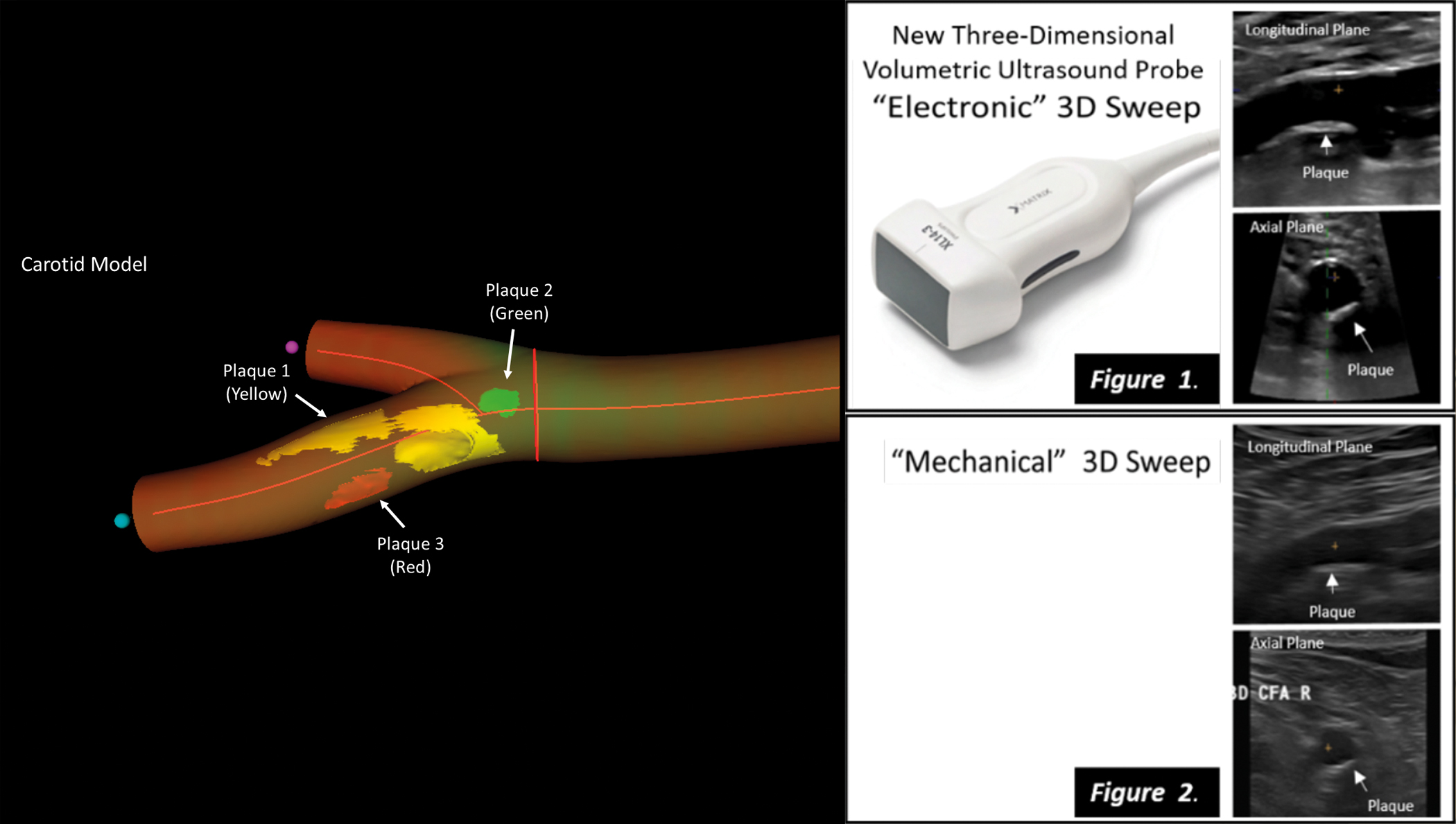 La ecografía vascular en 3D matrix identifica con precisión el daño cardiovascular en personas sanas
