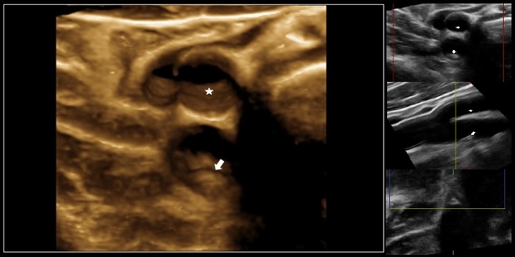 3D de la arteria femoral derecha donde se aprecia una evidente infiltración y protrusión de la pared del vaso hacia la luz que corresponde a una placa de aterosclerosis (flecha) antes de la bifurcación en sus ramas superficial y profunda (asterisco). Esta placa ocasiona una ligera obstrucción del tamaño de la luz vascular (entorno al 20%), es homogénea en su composición y no presenta datos de complicaciones como ulceras o trombos en su superficie. 