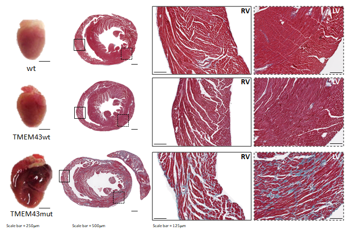 Mutation p.S358L in TMEM43 induces biventricular dysfunction and accumulation of fibrofatty tissue in the myocardium