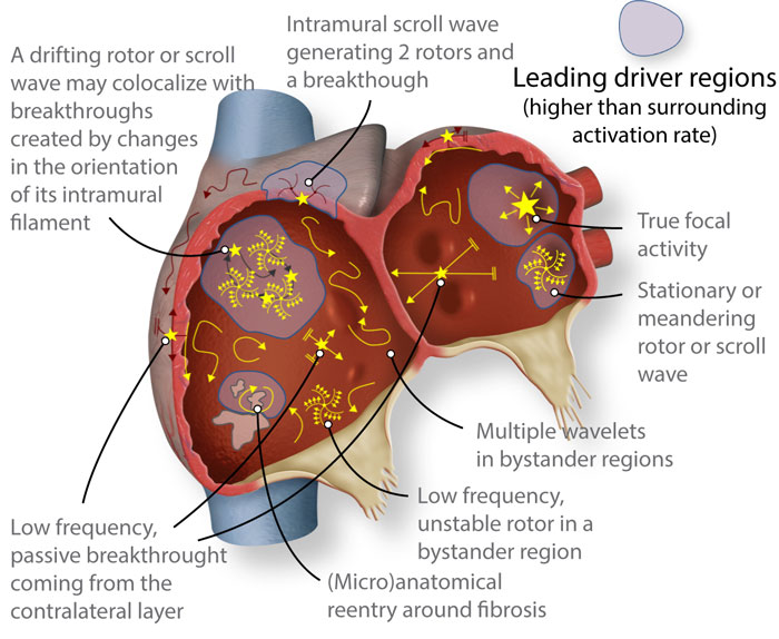 Figure 3. Schematic of structurally and electrically remodeled atria, where several reported patterns might coexist. However, atrial fibrillation may still be driven in a hierarchical fashion by specific regions with higher than surrounding activation rate (leading drivers). Such regions would host reentrant drivers in many cases, albeit not all reentrant activity would act as a driver, since rotors are commonly found in passive bystander regions.