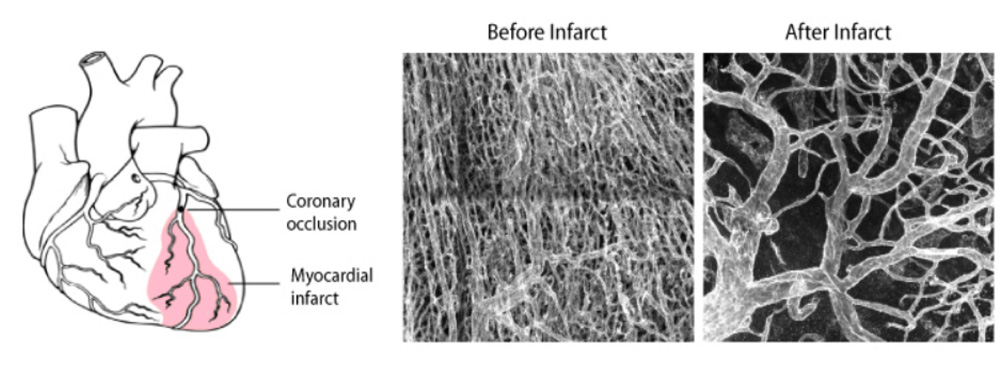 Figure 6 - Vascular remodelling after myocardial infarction. 