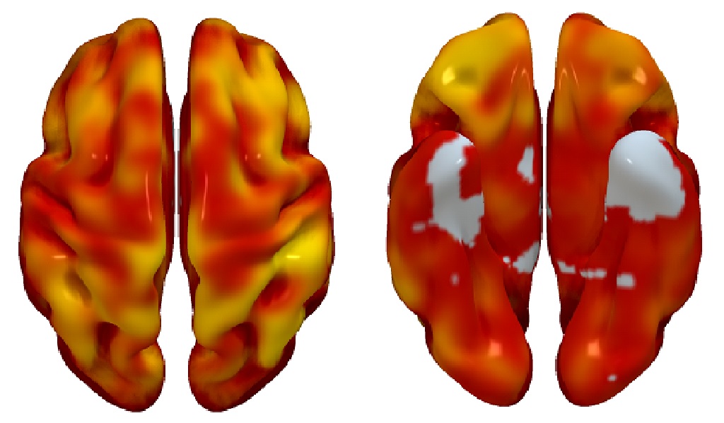 Reconstrucciones tridimensionales cerebral superior (imagen izquierda) e inferior (imagen derecha) donde se muestran aquellas regiones cerebrales con un menor metabolismo cerebral asociado con una mayor carga de placa en las carótidas. El color indica la magnitud de la asociación observada (de mayor a menor: amarillo a rojo. Gris indica zonas sin asociación).