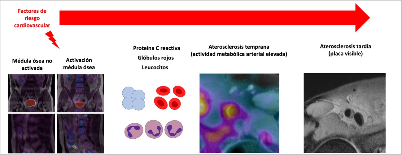 Bone marrow contributes to the development of atherosclerosis