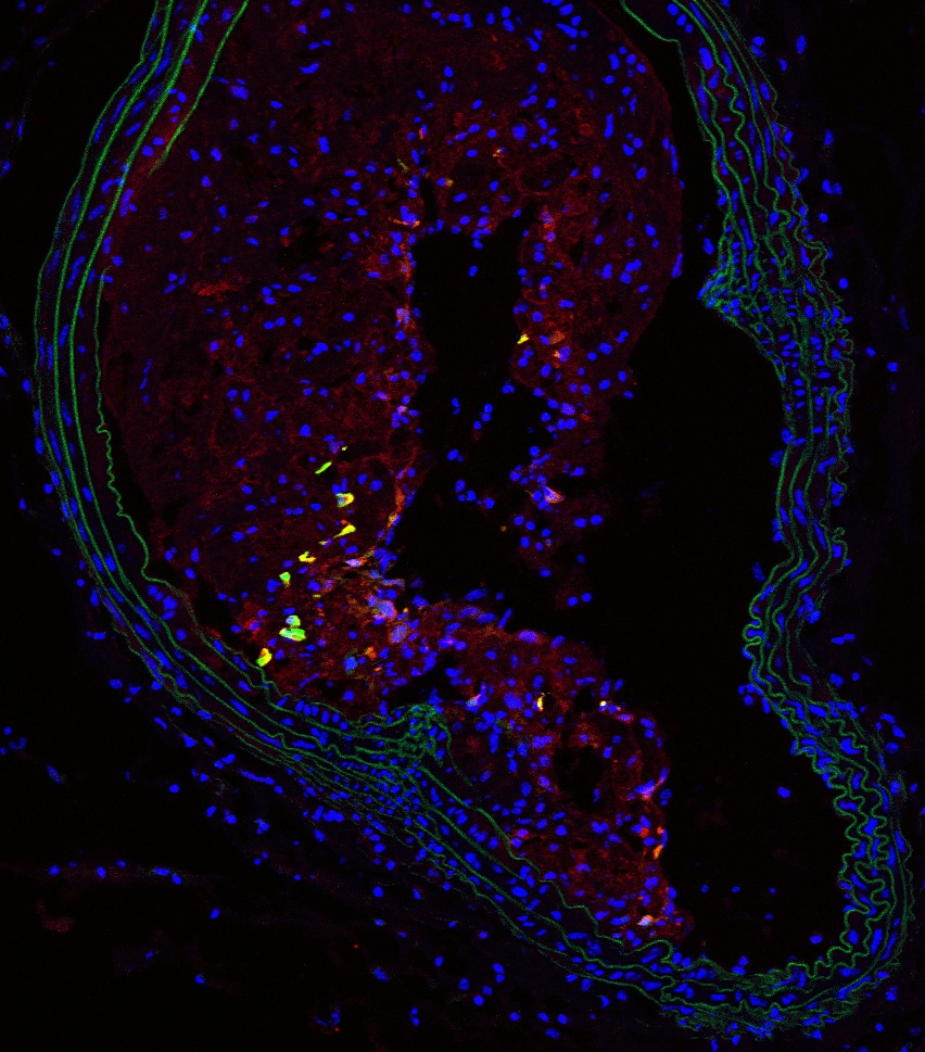 Nestin+ cells in an atherosclerotic plaque (yellow and red) in the brachial artery of an adult mouse. The layer of muscle cells (green) delimits the vessel lumen