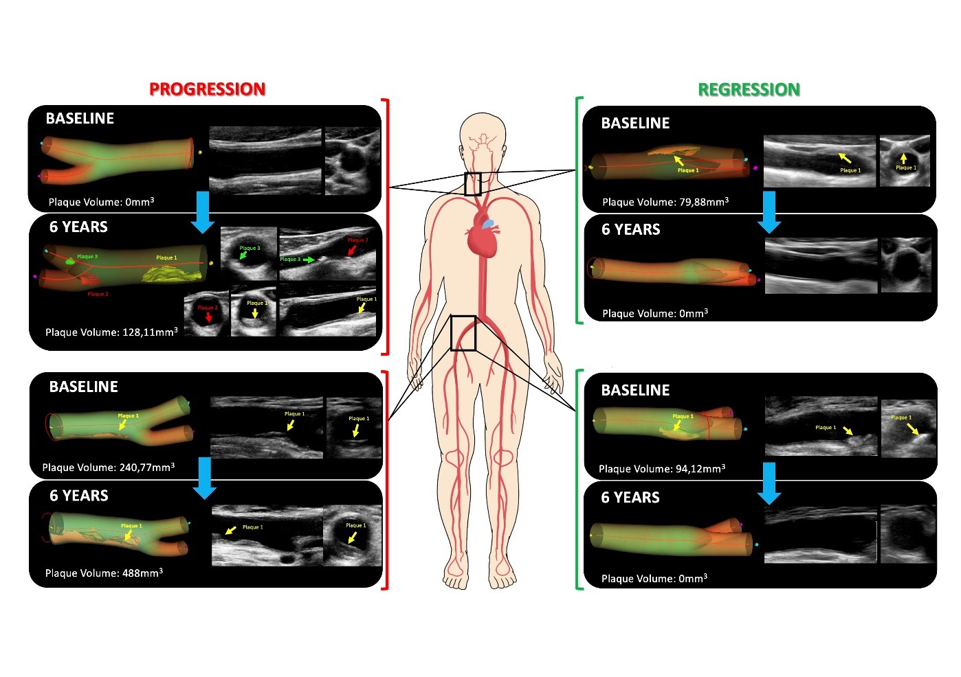 Casos de progresión de aterosclerosis (izquierda) y de regresión (desaparición de la misma, derecha)  en arterias carótidas (en el cuello) en las femorales (ingles). En cada caso se muestra el estudio basal (en la inclusión del participante, baseline) y el estudio 6 años después de la misma arteria. En cada caso, las imágenes de la derecha son las directamente obtenidas por el ecógrafo vascular, y a la izquierda la reconstrucción tridimensional.