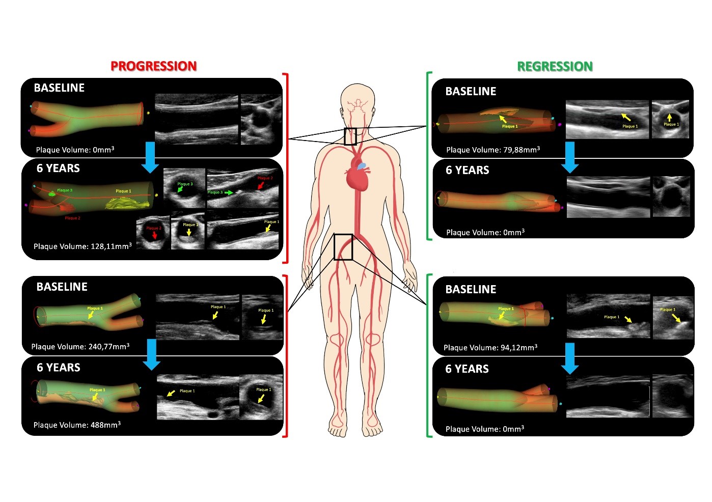 Representative results from participants showing atherosclerosis progression (left) and regression (disappearance of plaques, right) in arteries of the neck (carotids) and groin (femorals). Each image pair shows the results of the initial study at baseline and the follow-up study of the same artery 6 years later. The images show representative vascular ultrasound images on the right and 3-dimensional reconstructions on the left. 