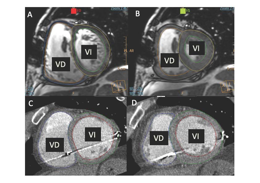 La figura muestra imágenes mediante resonancia magnética cardíaca (A y B) y tomografía computarizada (C y D) de un corazón en diástole (A y C) y sístole (B y D) para el cálculo de la función de ambos ventrículos. VD: Ventrículo derecho; VI: Ventrículo izquierdo. 