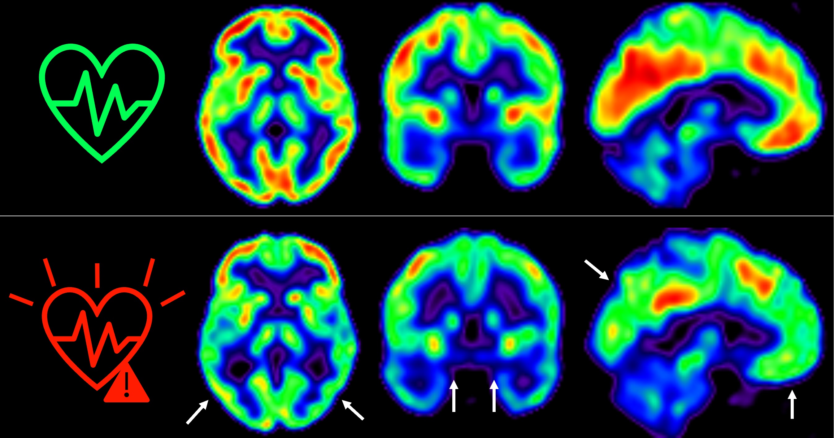 Las imágenes representan la captación de glucosa en cerebro medida por tomografía por emisión de positrones en individuos de mediana edad con bajo (arriba) o alto (abajo) riesgo cardiovascular sostenido a lo largo de 5 años. Los colores representan el consumo de glucosa cerebral, con rojo indicando un consumo más alto y azul más bajo