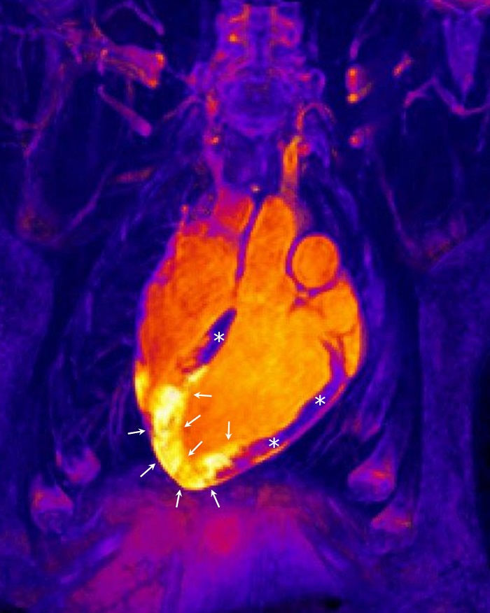 Imagen de resonancia magnética tridimensional en un sujeto tras un infarto agudo de miocardio. En el centro de la imagen aparece el corazón. El músculo cardiaco sano (no infartado) está marcado con asteriscos, mientras que las flechas señalan la región de corázon que ha sufrido el infarto. Con resonancia magnética se puede visualizar la extensión de area de inflamación y edema tras el infarto (zona amarilla señalada con las flechas). Haciendo resonancia magnéticas seriadas, se puede ver como esta reacción i