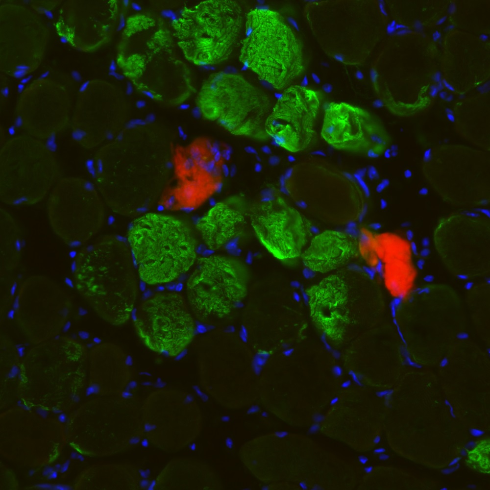 Daño local en las fibras musculares tras el ejercicio. Visualización del daño local en fibras de músculo esquelético (soleous y gastro) de ratón joven tras el ejercicio, mediante la tinción con marcadores de daño local como Filamina C (verde) y Evans Blue (rojo), y los núcleos (en azul) de fibras.