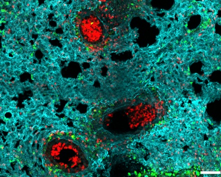 Neutrófilos (rojo) se acumulan en los alveolos de un pulmón infectado con gripe 