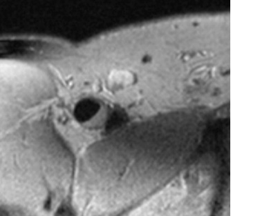 A cholesterol plaque in a carotid artery, visualized by vascular magnetic resonance imaging.