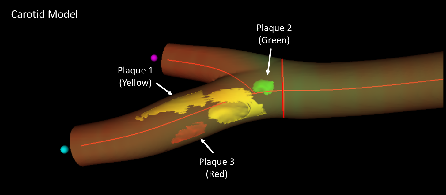 Modelo 3D de la arteria femoral derecha que se obtiene con la imagen 3D real donde se representa la localización, número y extensión de las distintas placas de aterosclerosis, hasta 3 placas en el caso de este paciente (flechas), distribuidas a lo largo de la bifurcación femoral y su rama superficial