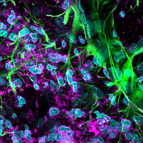 Imagen obtenida por microscopía confocal en la que se observa el borde de la cicatriz glial producida tras el infarto cerebral, lo cual dificulta la posterior regeneración de la zona. Este evento es atenuado en gran medida a través del tratamiento con metoprolol intravenoso pre-reperfusión. 