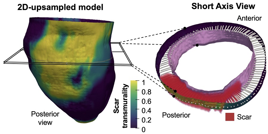 Representación de la metodología empleada para la evaluación tridimensional del miocardio infartado y su grado de transmuralidad en un caso representativo de imágenes de resonancia magnética cardíaca obtenidas con secuencias convencionales de realce tardío 2D