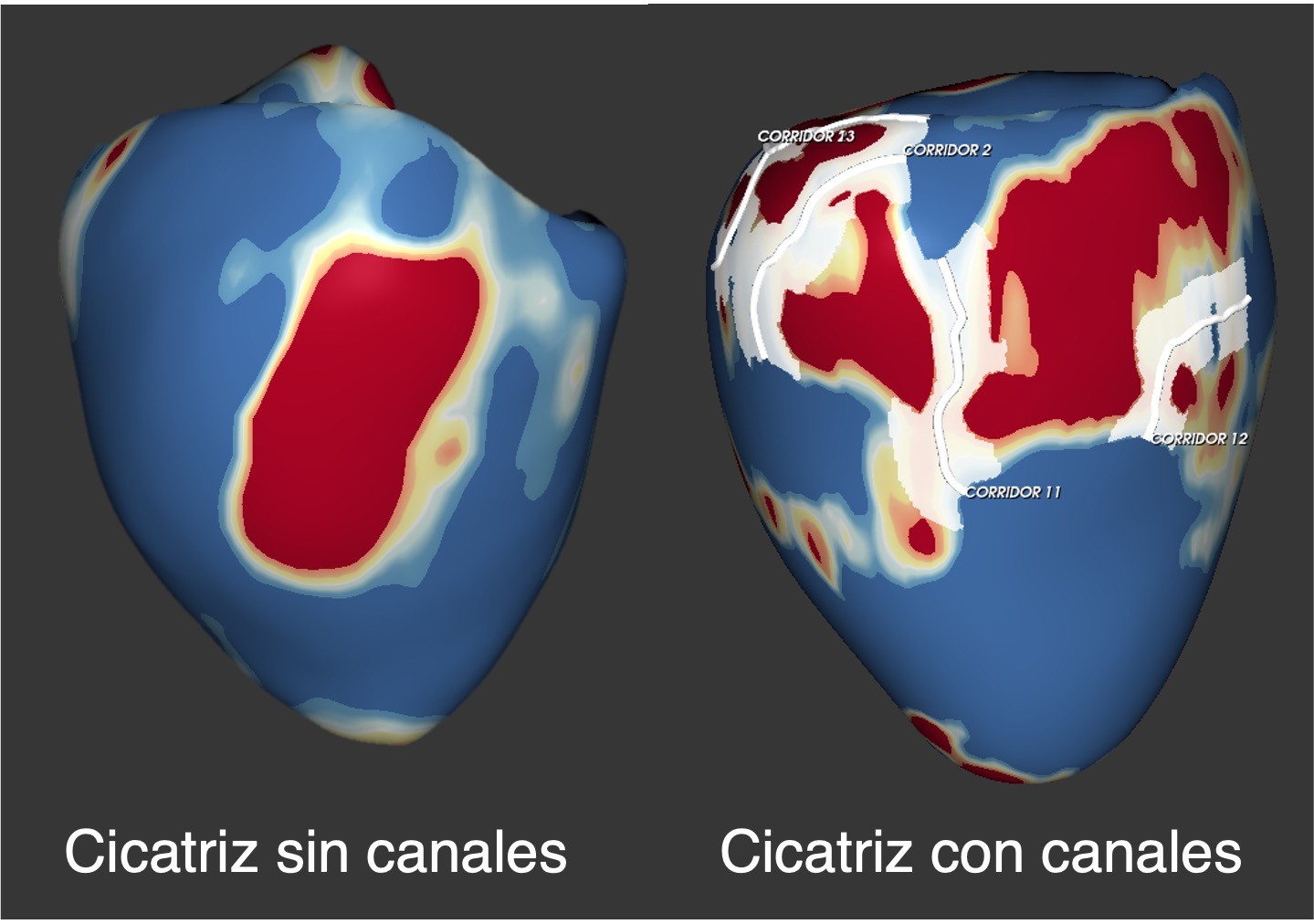 Resonancia magnética de dos pacientes con miocardiopatía dilatada. A la izquierda, paciente con fibrosis sin canales de conducción y a la derecha, paciente con múltiples canales.