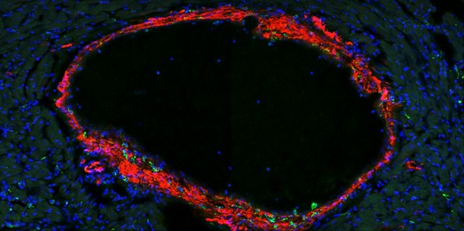 Arteria coronaria dilatada en un nuevo modelo experimental de enfermedad de Kawasaki.