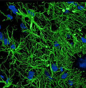 Astrocitos hipertrofiados y reactivos (GFAP-verde) imagen de microscopia Confocal deconvolucionada con Huygens.