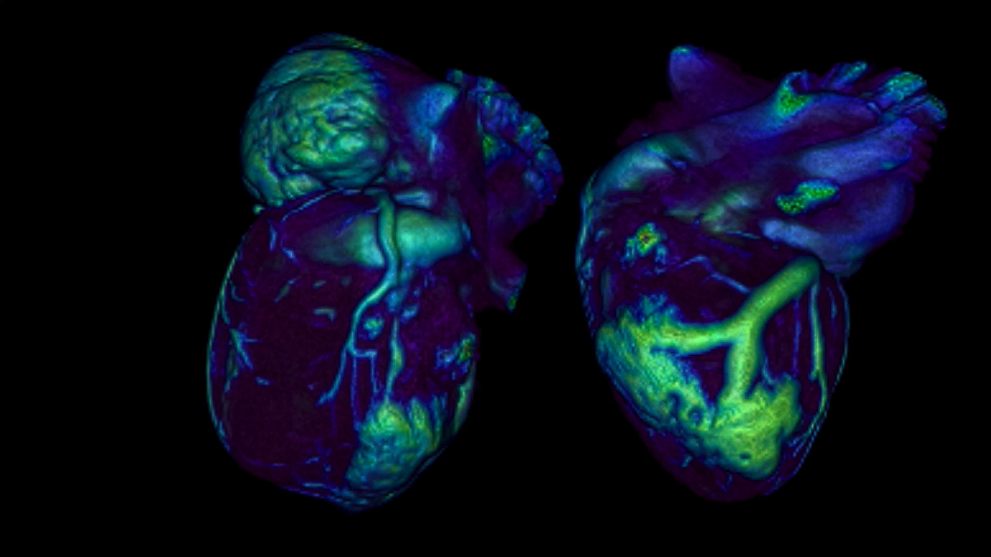 Imagen de un corazón (o imágenes de corazones) obtenida por tomografía computarizada que muestra la marcada dilatación arterial y las lesiones coronarias (en verde) inducidas por la activación de la vía de hipoxia en un modelo experimental de la enfermedad de Kawasaki 