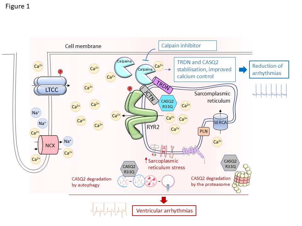 The R33Q mutation in calsequestrin 2 (CASQ2) disrupts calcium control in heart cells and activates protein-degradation mechanisms.