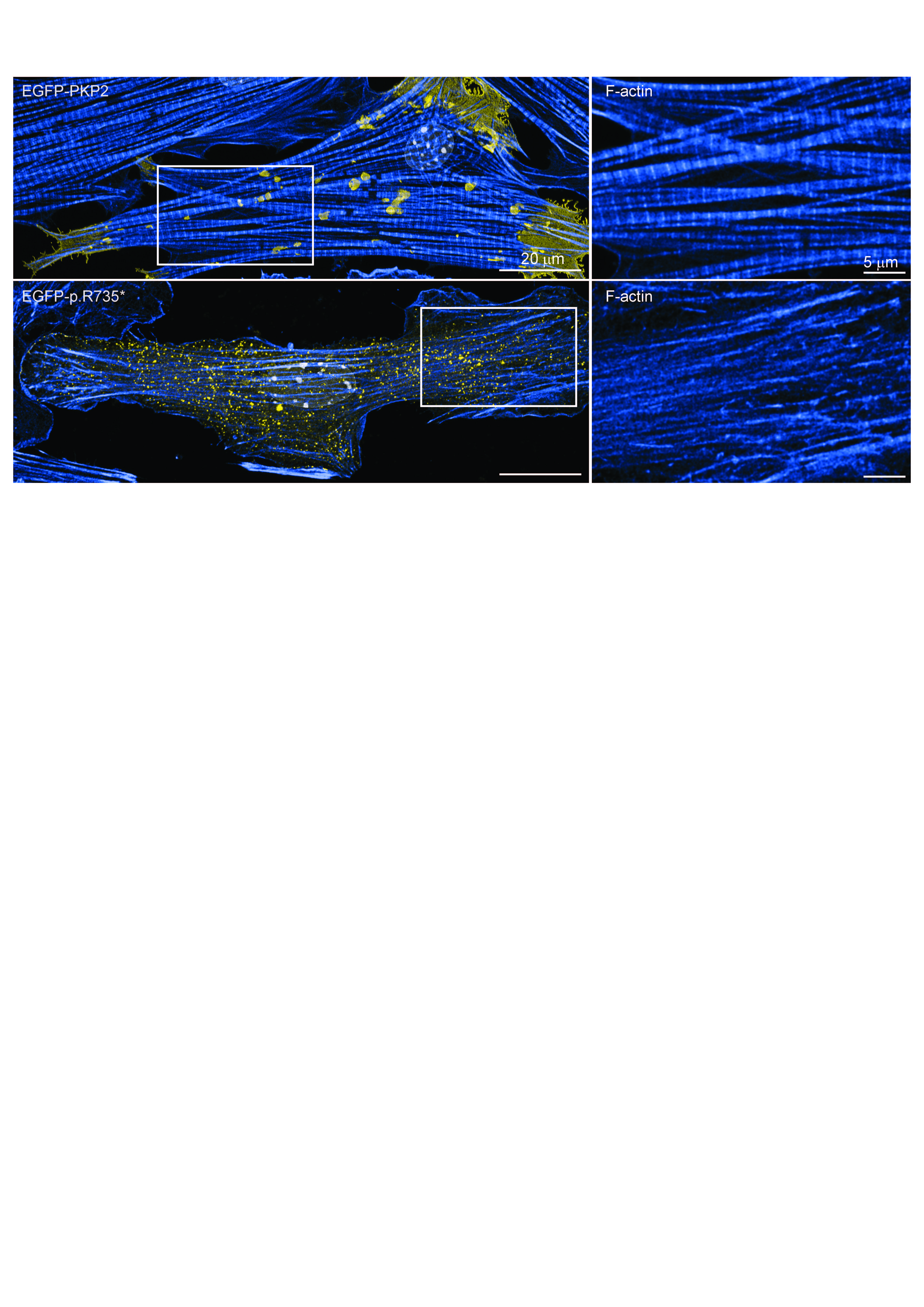 Imágenes de microscopía de células de corazón (cardiomiocitos) que muestran cómo se pierde la estructura de la célula en presencia de la proteína mutada. La imagen superior muestra la estructura ordenada de una célula control (EGFP-PKP2). La imagen inferior muestra la estructura alterada de una célula con la mutación (EGFP-p.R735*). A la derecha se muestra una ampliación de las dos imágenes de la izquierda.