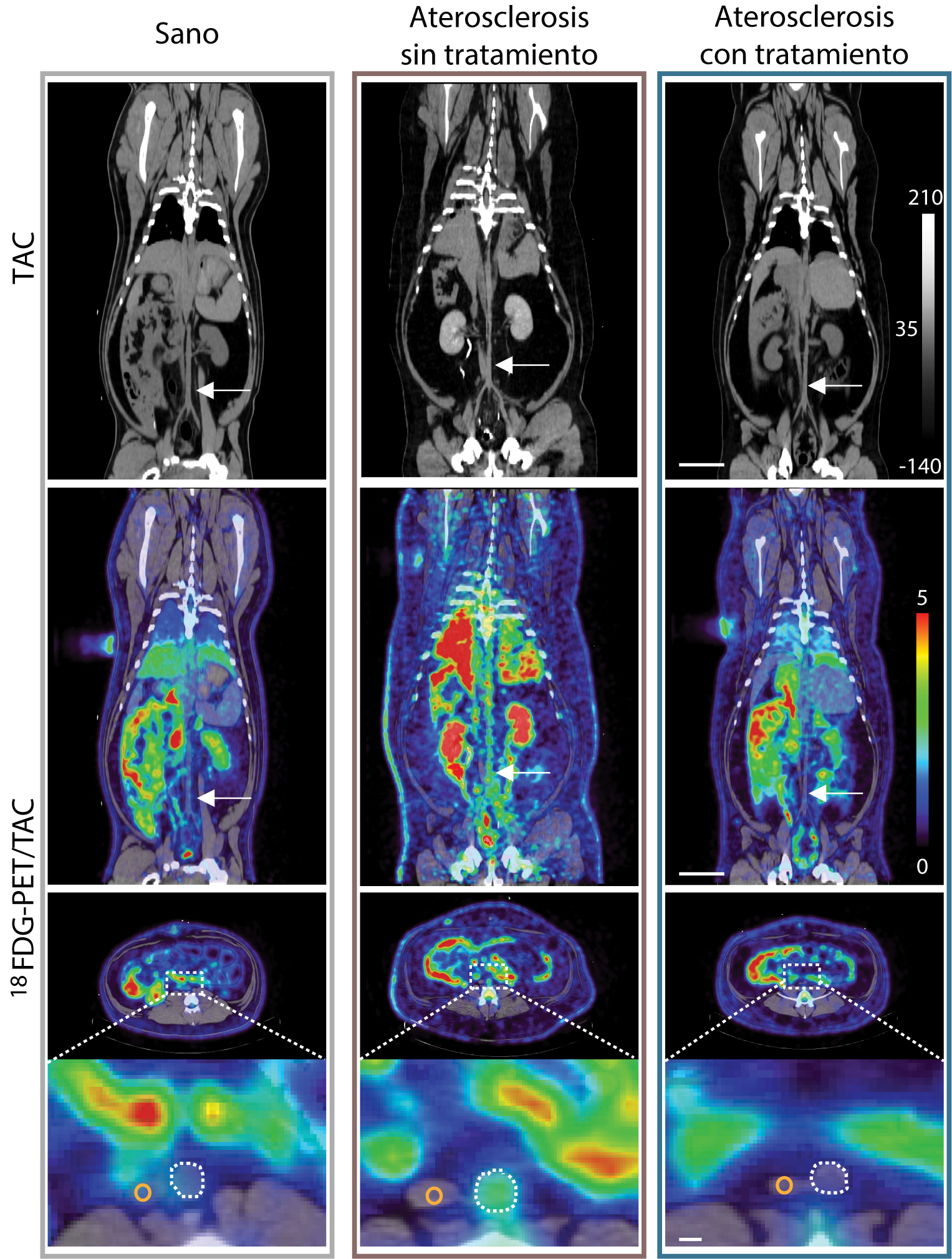 Las imágenes de TAC y 18FDG-PET muestran la actividad de la aterosclerosis en la aorta abdominal de cerdos. La fila superior presenta la imagen anatómica (TAC) y su señal metabólica superpuesta (18FDG), que revela el metabolismo activo. Abajo, un corte transversal destaca la aorta. La captación de 18FDG es baja en cerdos sanos, aumenta con la aterosclerosis sin tratar y se reduce tras el tratamiento, indicando menor actividad de la enfermedad.