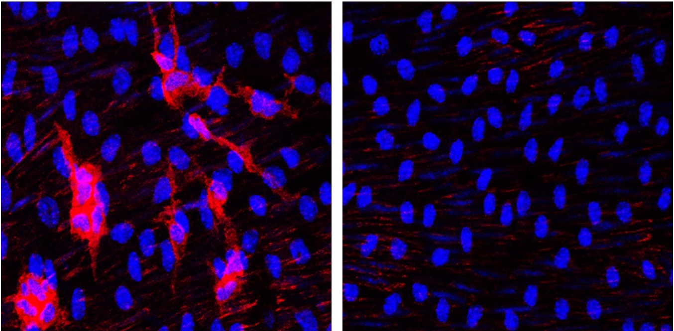 La acumulación de leucocitos (células en rojo) en la aorta de ratones progeroides (izquierda) se previene completamente al eliminar progerina en las células de músculo liso vascular (derecha).