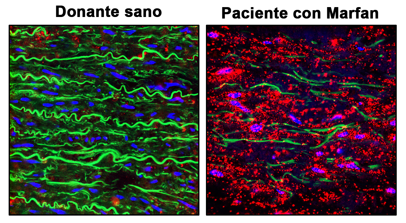 mágenes de la aorta de un individuo sano y de un paciente de síndrome de Marfan mostrando la desintegración de las fibras elásticas (en verde) y la sobre-activación de la proteína PRKG (puntos rojos).