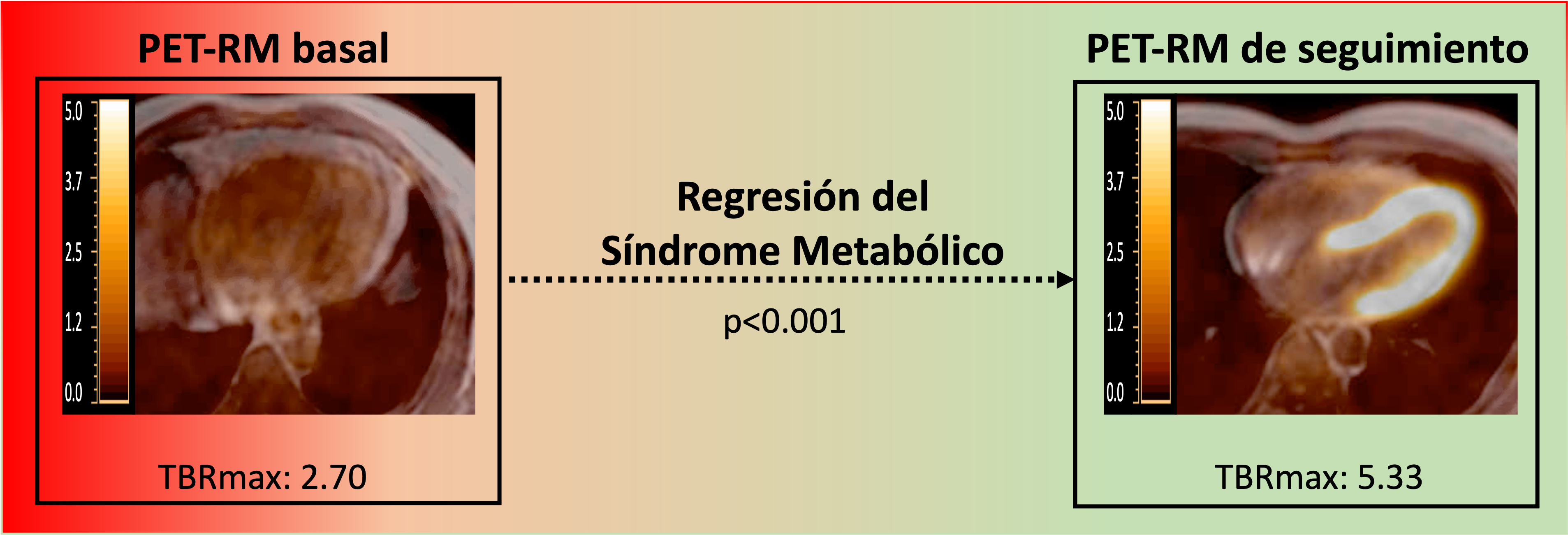 Si el síndrome metabólico desaparece, podemos ver como el corazón vuelve a consumir glucosa normalmente