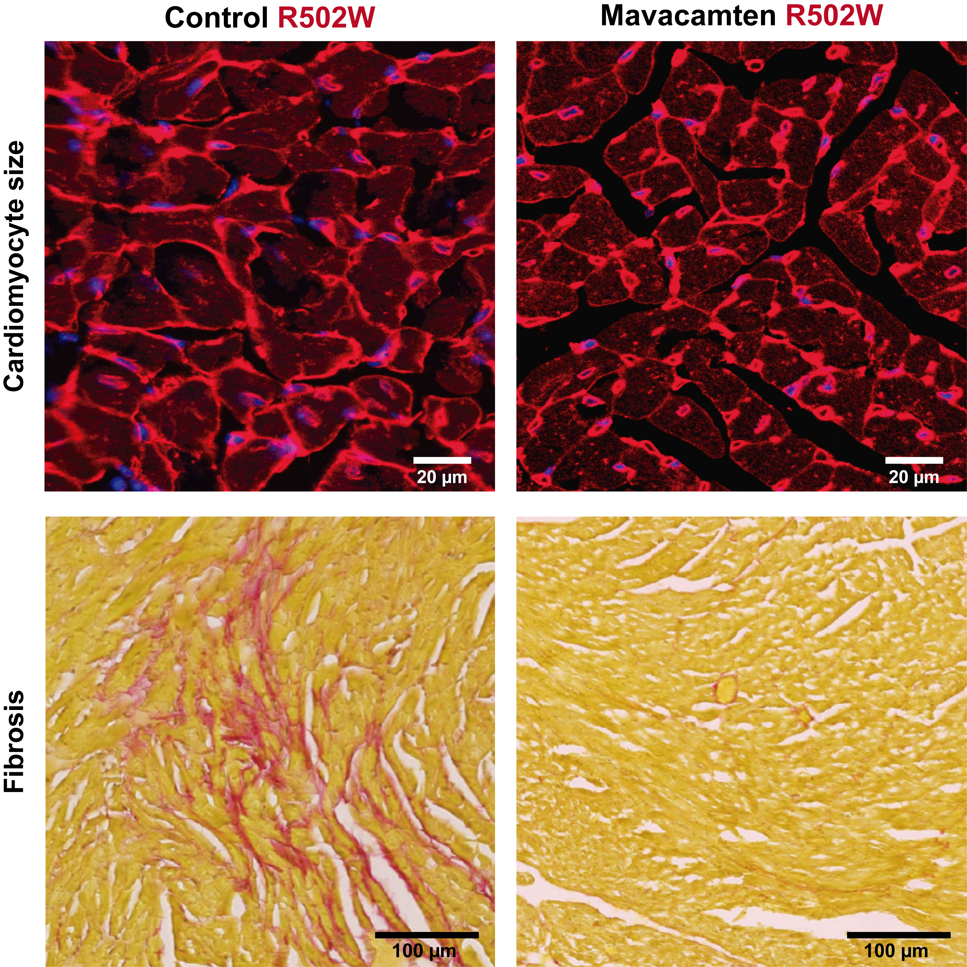 Imágenes de microscopía del corazón de ratones R502W sin tratar (izquierda) y tratados con mavacamten (derecha). La fila superior muestra el tamaño de las células cardíacas (cardiomiocitos), aumentado en el animal enfermo y reducido tras el tratamiento. La fila inferior muestra la fibrosis, acumulación de colágeno en el músculo cardíaco, abundante en animales R502W sin tratar y reducida tras el tratamiento con mavacamten.