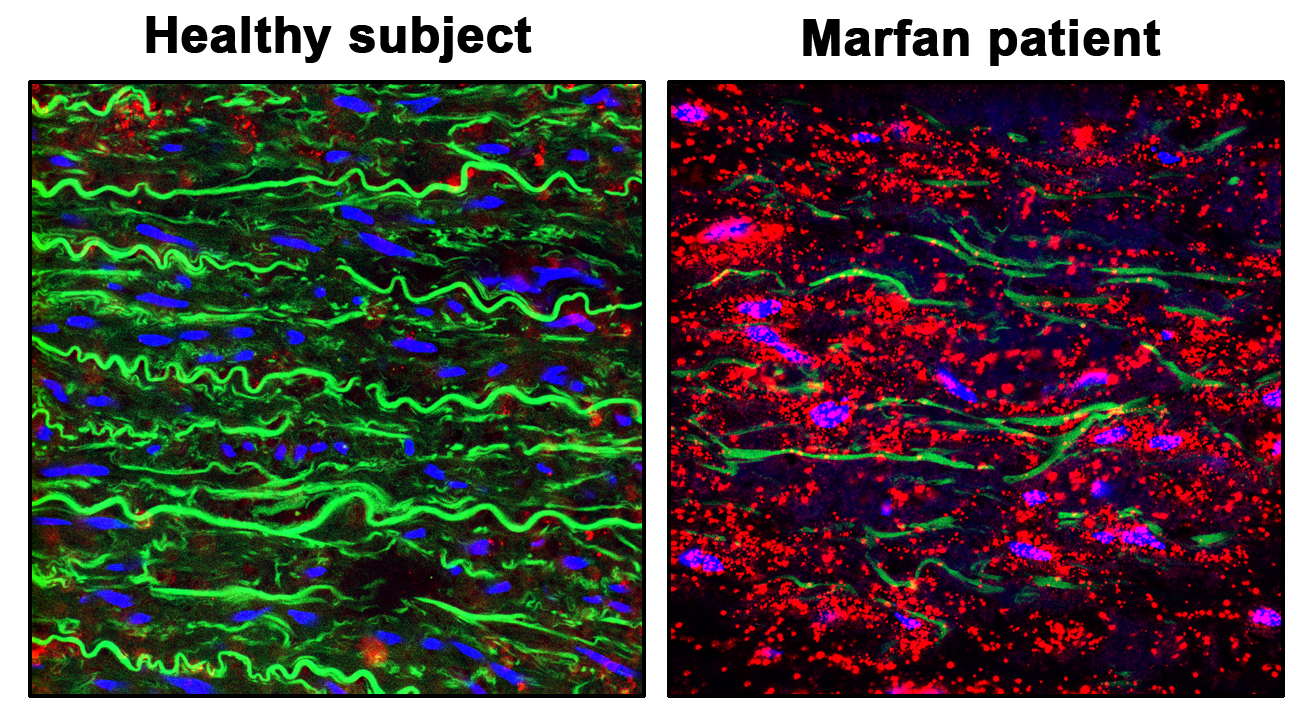 Staining showing pVASP-S239 (red), elastic fibers (green) and nuclei (blue) in the aortic wall of a healthy donor (Healthy Aorta) and a patient with Marfan Syndrome (Diseased Aorta from Marfan Patient). The images show how the NO-sGC-PRKGI pathway is over-activated in the aortic wall from Marfan patien